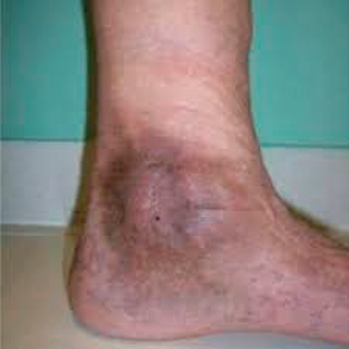 servicio curaciones a domicilio, curaciones a domicilio